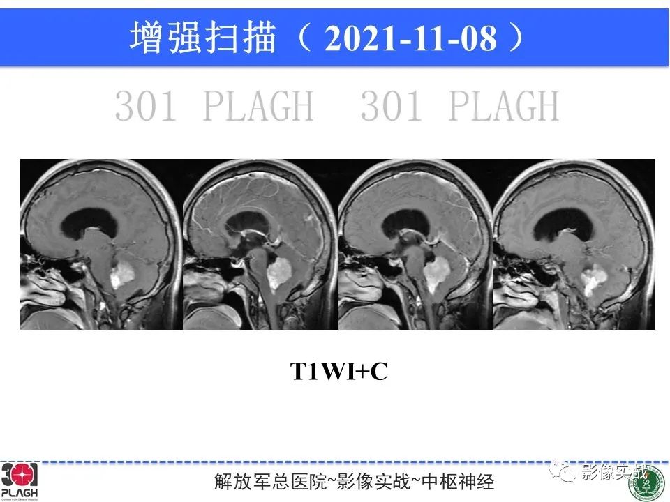 影像PPT - 【病例】四脑室非典型脉络丛乳头状瘤1例CT及MR-14