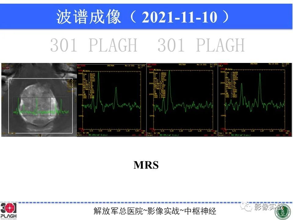 影像PPT - 【病例】四脑室非典型脉络丛乳头状瘤1例CT及MR-17