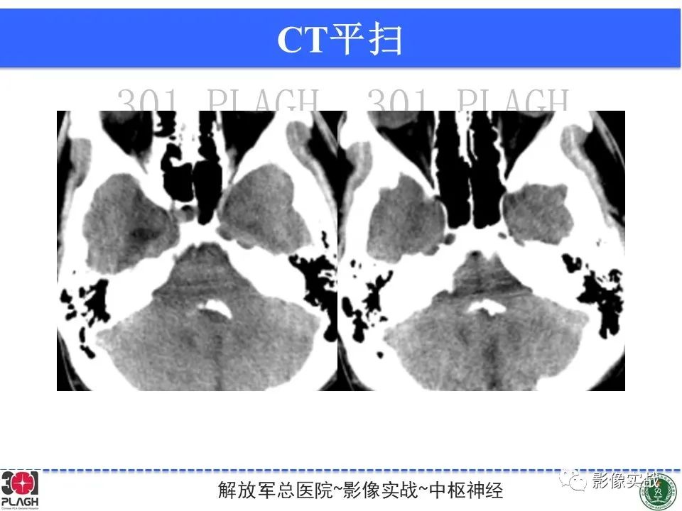 影像PPT - 【病例】四脑室非典型脉络丛乳头状瘤1例CT及MR-18
