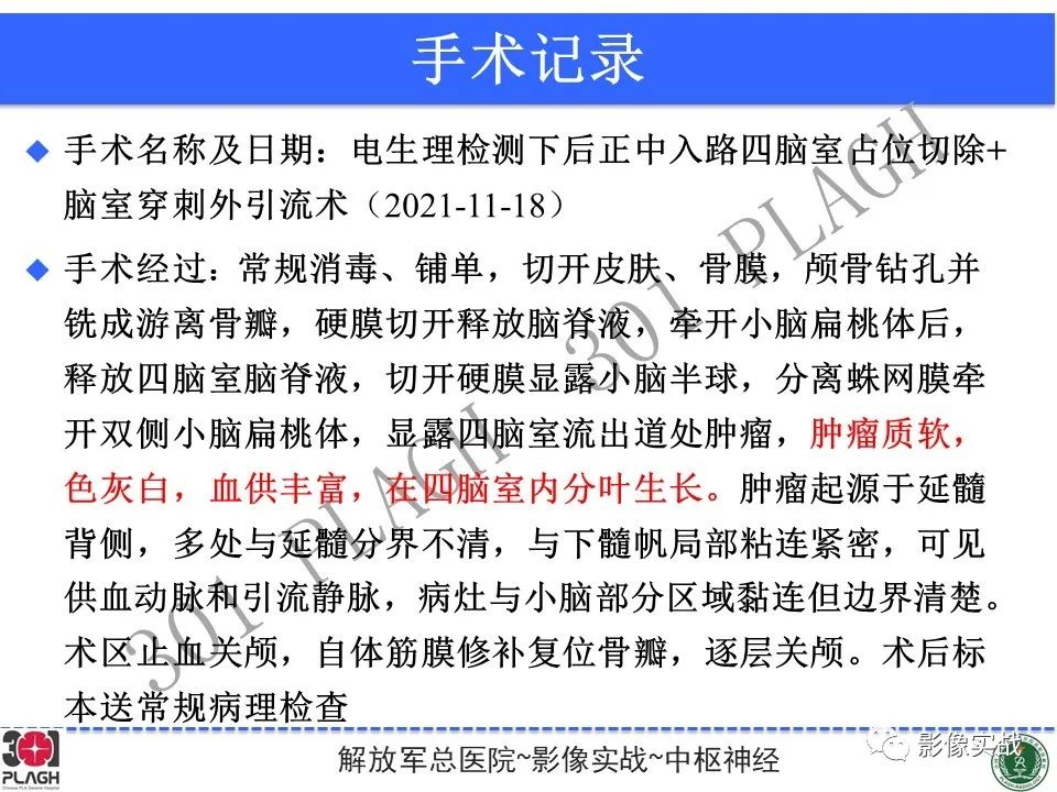 影像PPT - 【病例】四脑室非典型脉络丛乳头状瘤1例CT及MR-26