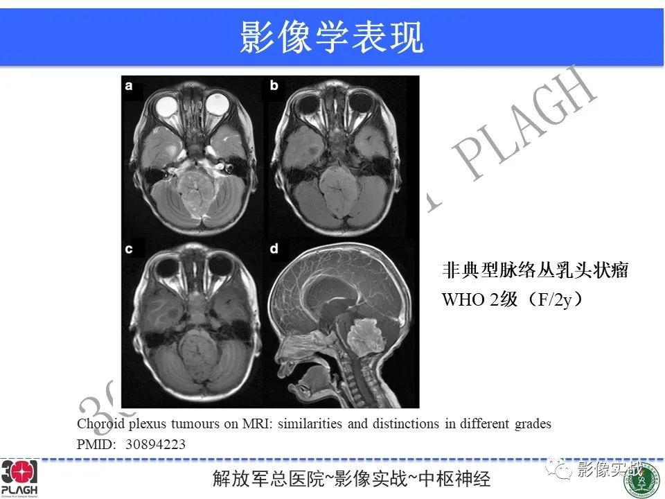 影像PPT - 【病例】四脑室非典型脉络丛乳头状瘤1例CT及MR-31
