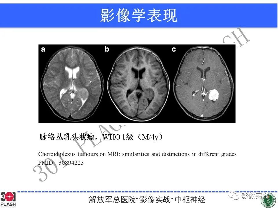 影像PPT - 【病例】四脑室非典型脉络丛乳头状瘤1例CT及MR-32