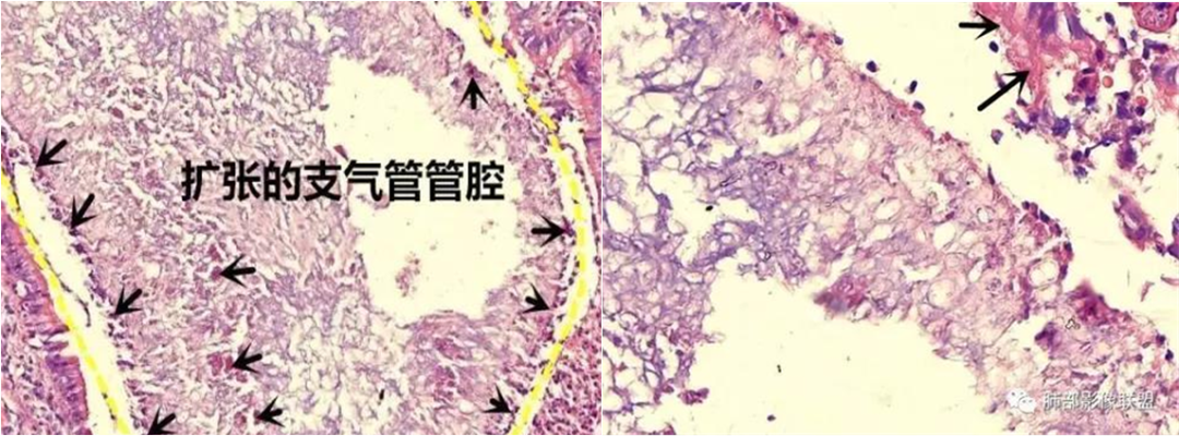 影像PPT - 肺曲菌病分型及 CT 表现-5 影像PPT - 肺曲菌病分型及 CT 表现-5