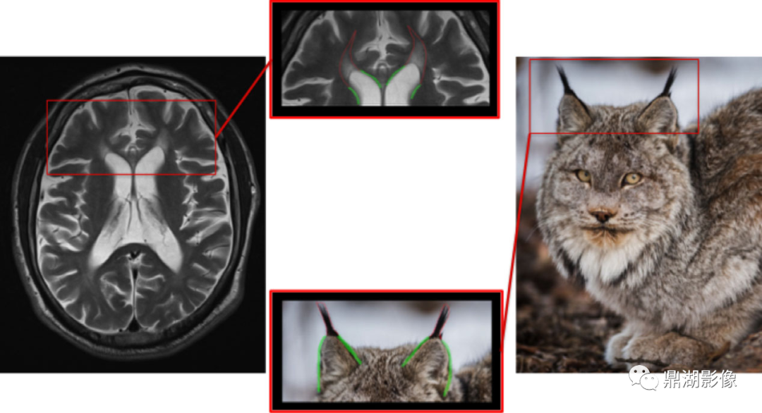 影像PPT - 猞猁耳征-1 影像PPT - 猞猁耳征-1