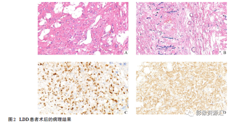 影像PPT - 小脑发育不良性神经节细胞瘤1例及文献复习-2 影像PPT - 小脑发育不良性神经节细胞瘤1例及文献复习-2