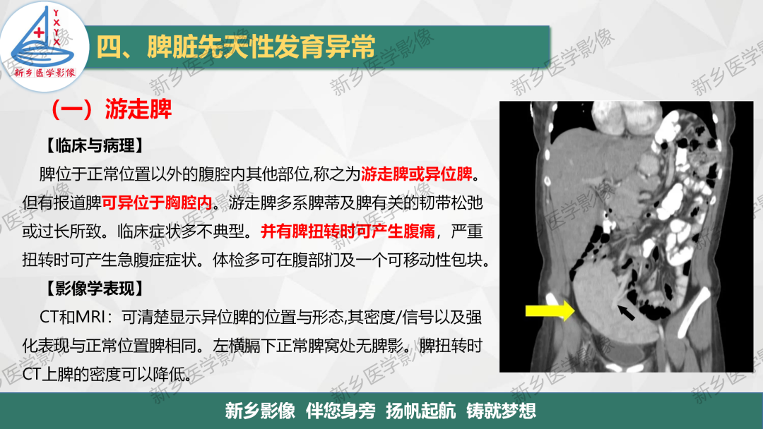 影像PPT - 【PPT】脾脏正常解剖及常见病变的影像表现-16