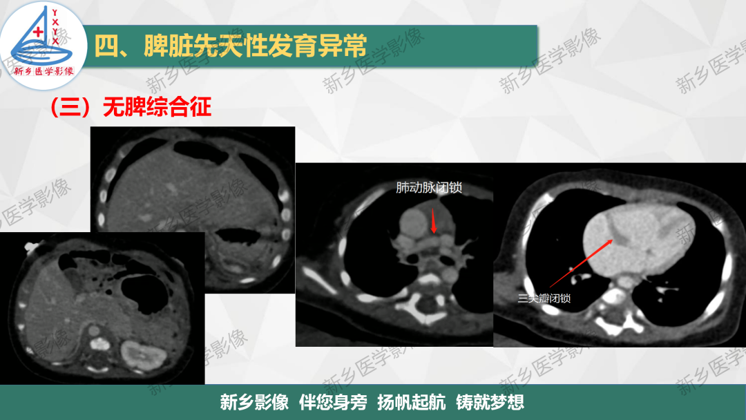 影像PPT - 【PPT】脾脏正常解剖及常见病变的影像表现-20