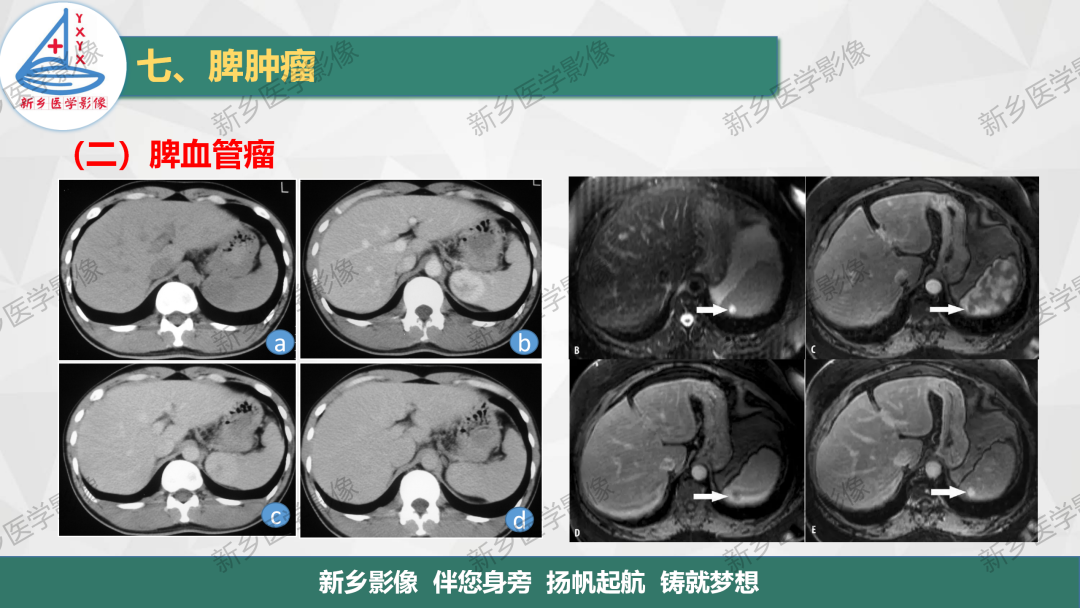 影像PPT - 【PPT】脾脏正常解剖及常见病变的影像表现-33