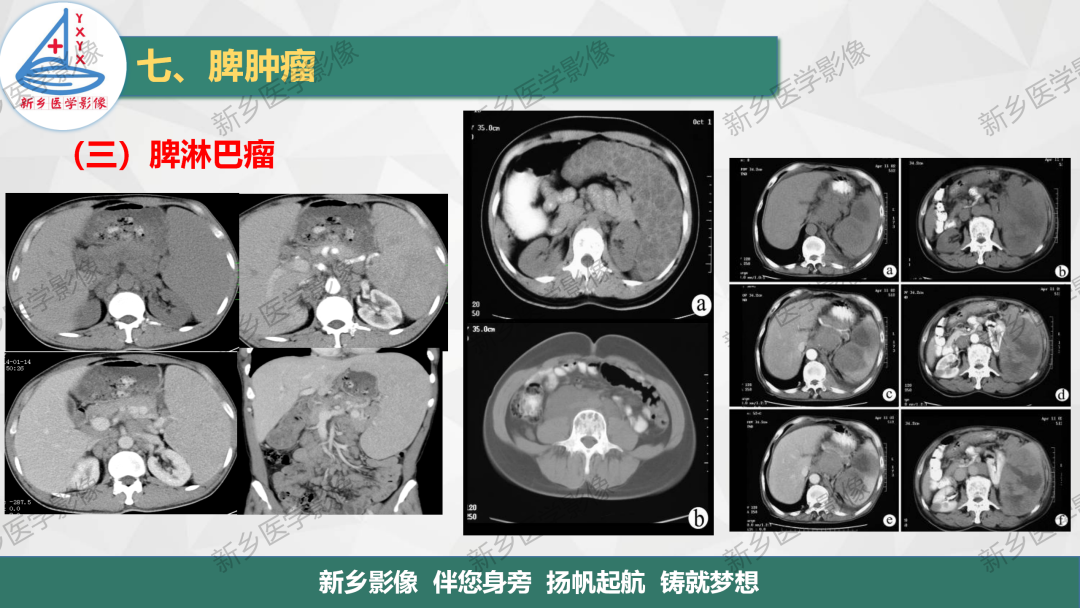 影像PPT - 【PPT】脾脏正常解剖及常见病变的影像表现-36