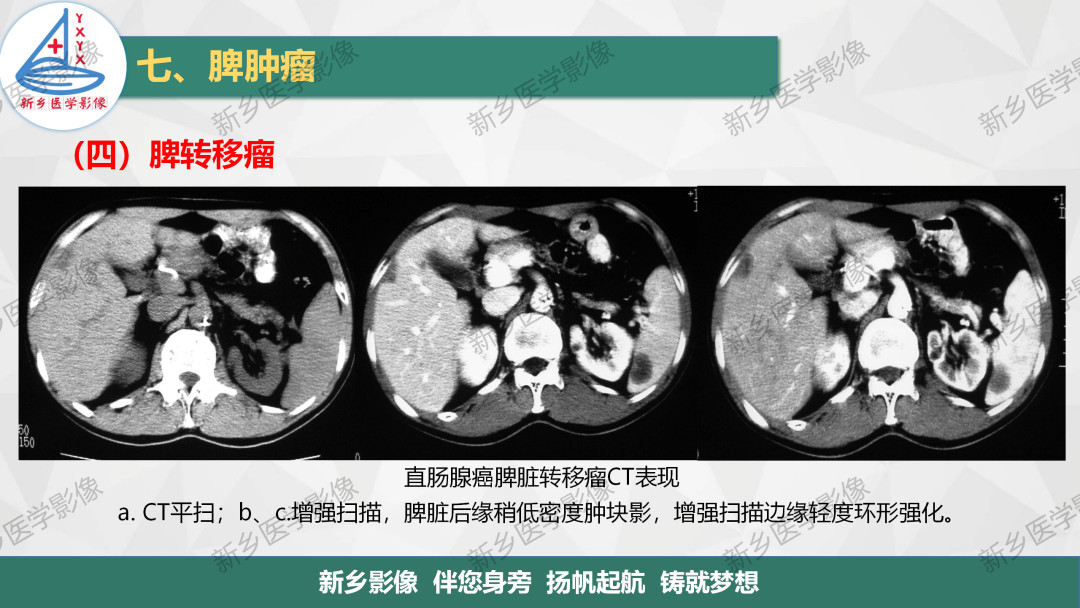 影像PPT - 【PPT】脾脏正常解剖及常见病变的影像表现-38
