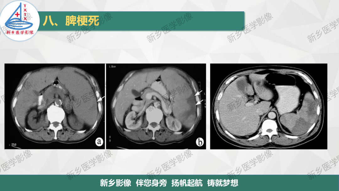 影像PPT - 【PPT】脾脏正常解剖及常见病变的影像表现-41