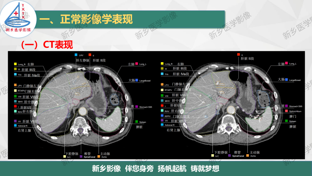 影像PPT - 【PPT】脾脏正常解剖及常见病变的影像表现-5