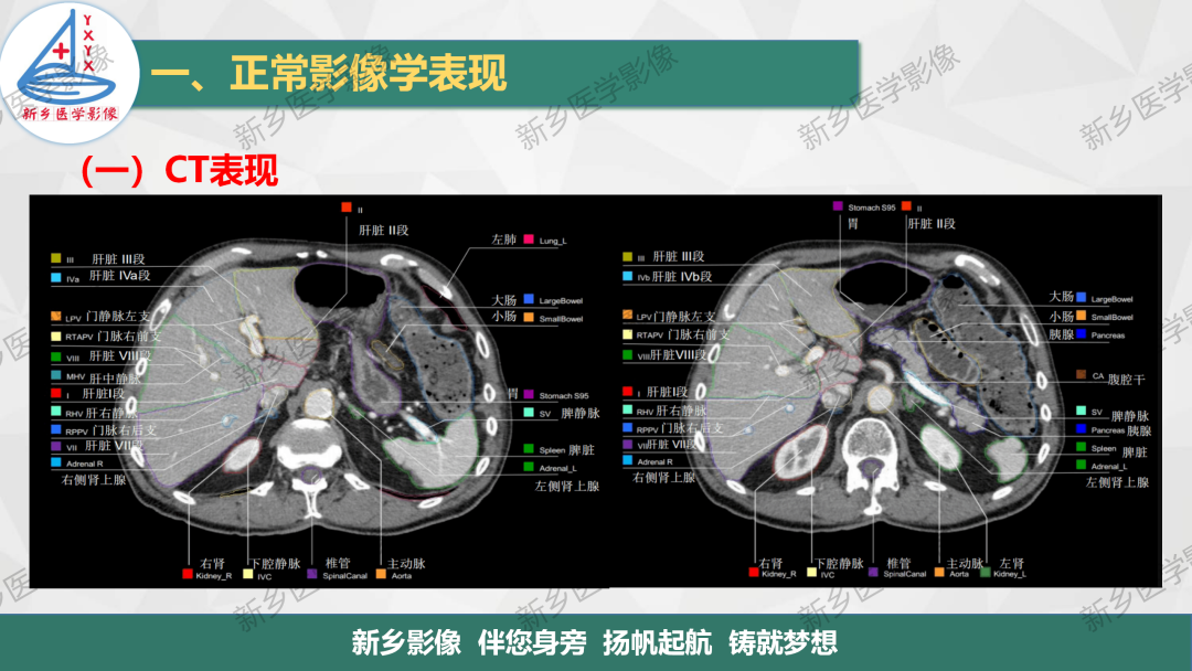 影像PPT - 【PPT】脾脏正常解剖及常见病变的影像表现-6