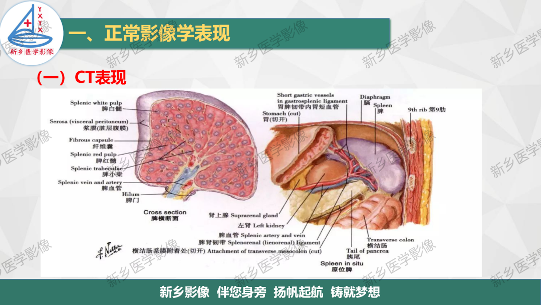 影像PPT - 【PPT】脾脏正常解剖及常见病变的影像表现-4