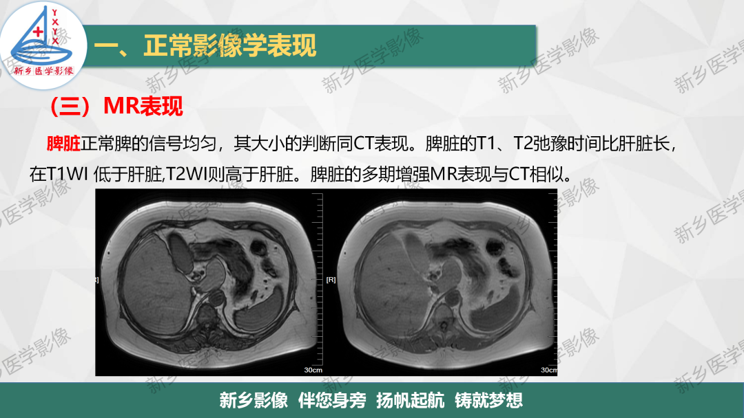 影像PPT - 【PPT】脾脏正常解剖及常见病变的影像表现-7