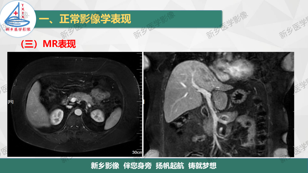 影像PPT - 【PPT】脾脏正常解剖及常见病变的影像表现-12