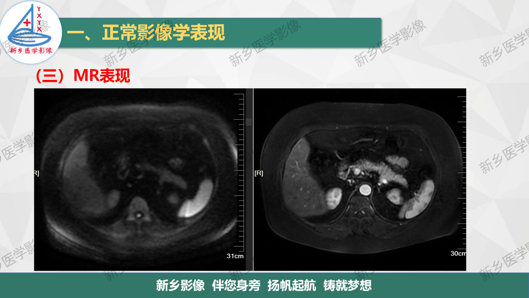 影像PPT - 【PPT】脾脏正常解剖及常见病变的影像表现-11
