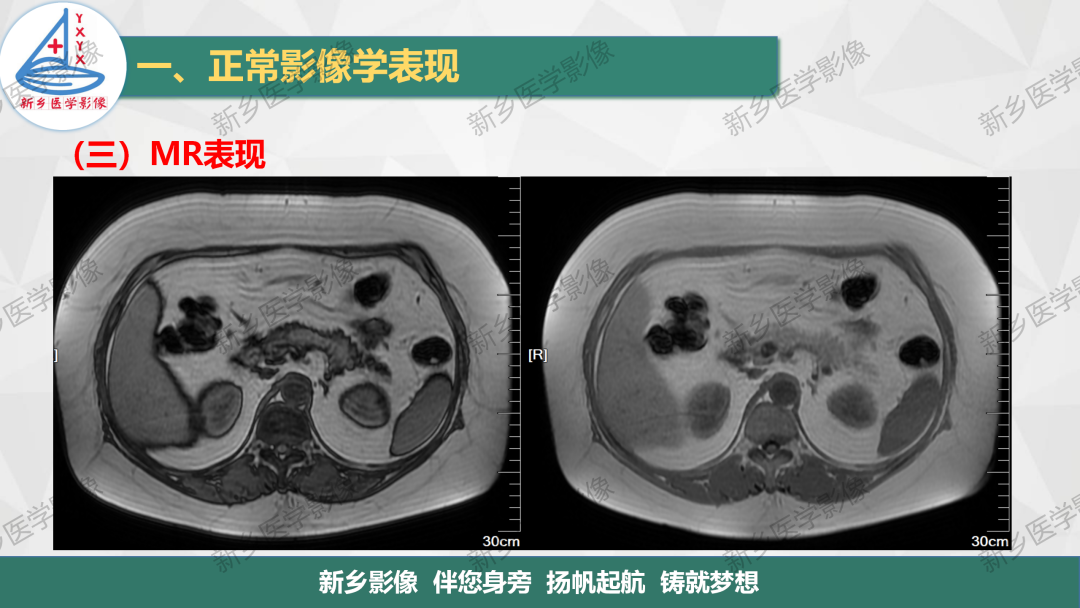 影像PPT - 【PPT】脾脏正常解剖及常见病变的影像表现-8