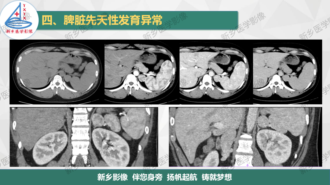 影像PPT - 【PPT】脾脏正常解剖及常见病变的影像表现-15