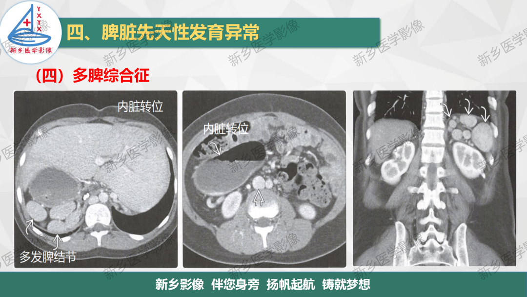影像PPT - 【PPT】脾脏正常解剖及常见病变的影像表现-18