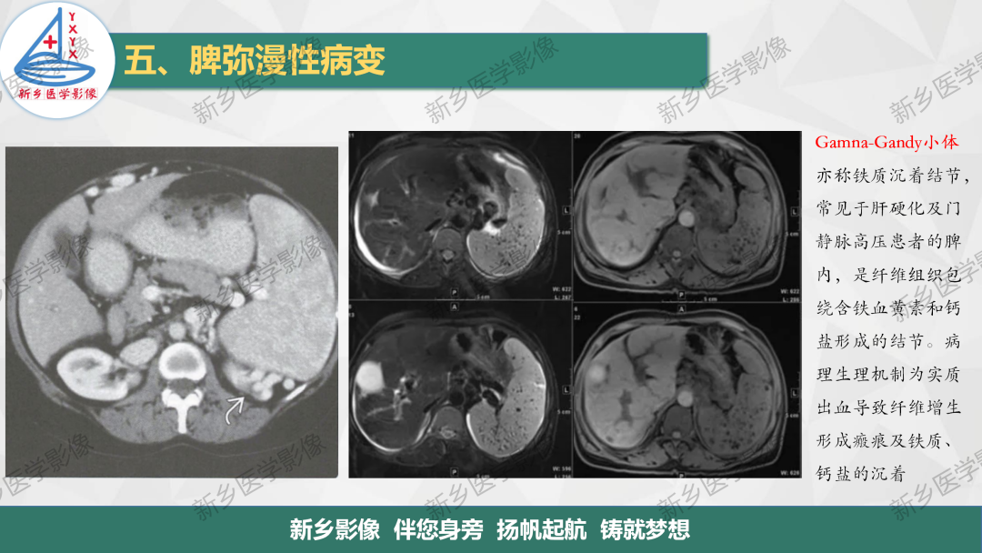 影像PPT - 【PPT】脾脏正常解剖及常见病变的影像表现-20