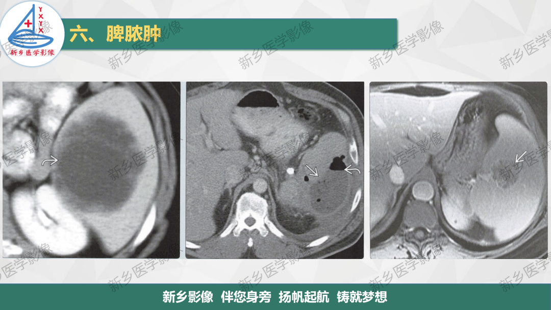 影像PPT - 【PPT】脾脏正常解剖及常见病变的影像表现-21