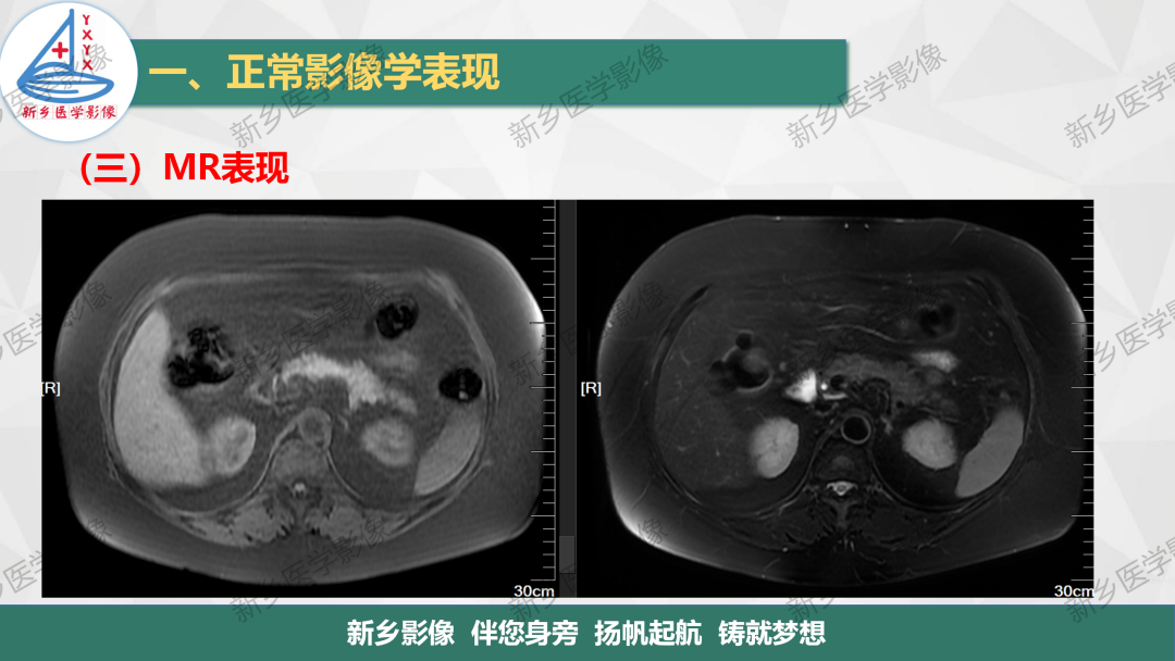 影像PPT - 【PPT】脾脏正常解剖及常见病变的影像表现-2