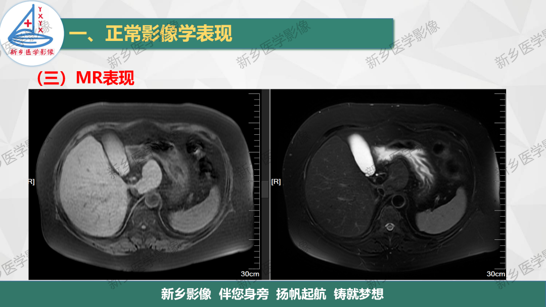 影像PPT - 【PPT】脾脏正常解剖及常见病变的影像表现-1
