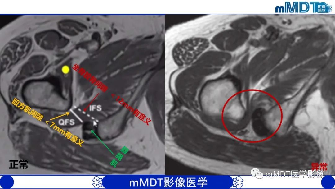 影像PPT - 【PPT】髋关节疼痛影像与临床(二)-5 影像PPT - 【PPT】髋关节疼痛影像与临床(二)-5