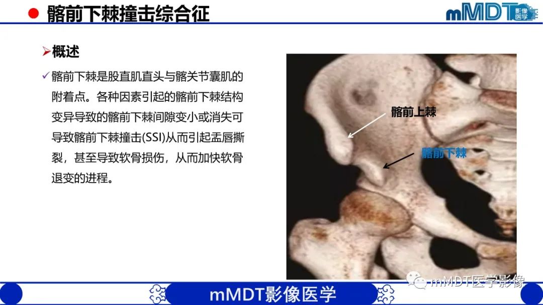 影像PPT - 【PPT】髋关节疼痛影像与临床(二)-7 影像PPT - 【PPT】髋关节疼痛影像与临床(二)-7