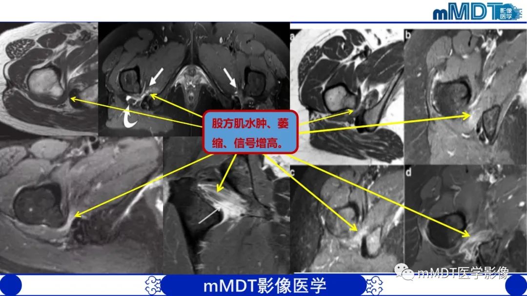 影像PPT - 【PPT】髋关节疼痛影像与临床(二)-6 影像PPT - 【PPT】髋关节疼痛影像与临床(二)-6