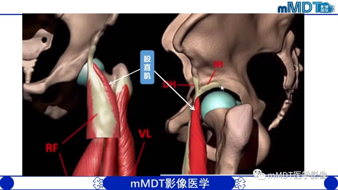 影像PPT - 【PPT】髋关节疼痛影像与临床(二)-8 影像PPT - 【PPT】髋关节疼痛影像与临床(二)-8