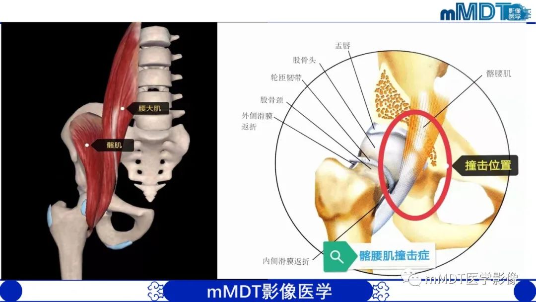 影像PPT - 【PPT】髋关节疼痛影像与临床(二)-10 影像PPT - 【PPT】髋关节疼痛影像与临床(二)-10