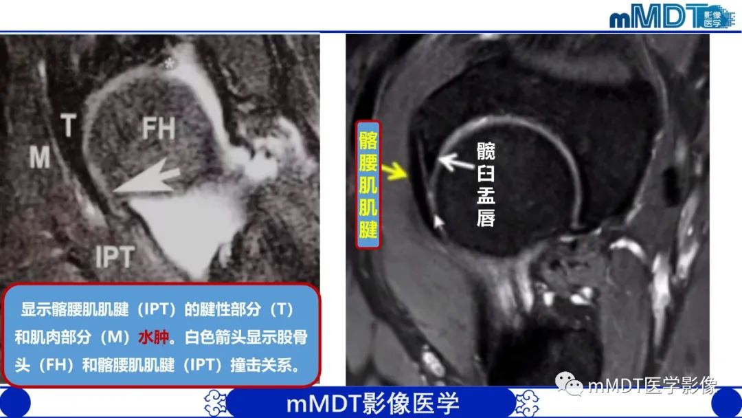 影像PPT - 【PPT】髋关节疼痛影像与临床(二)-11 影像PPT - 【PPT】髋关节疼痛影像与临床(二)-11