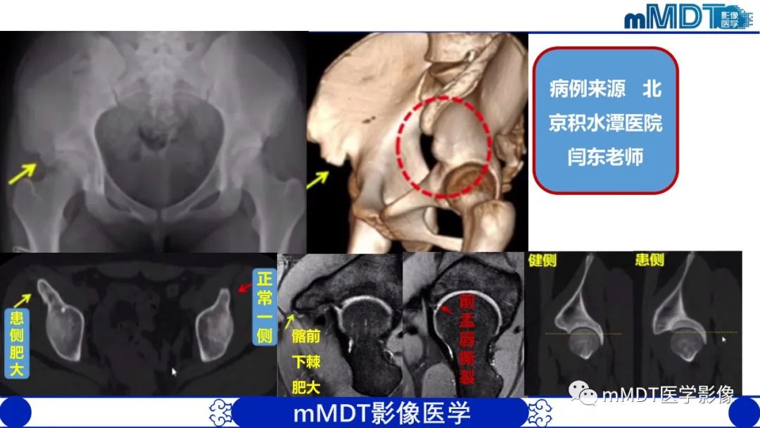 影像PPT - 【PPT】髋关节疼痛影像与临床(二)-9 影像PPT - 【PPT】髋关节疼痛影像与临床(二)-9