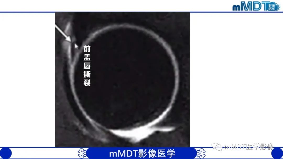 影像PPT - 【PPT】髋关节疼痛影像与临床(二)-12 影像PPT - 【PPT】髋关节疼痛影像与临床(二)-12