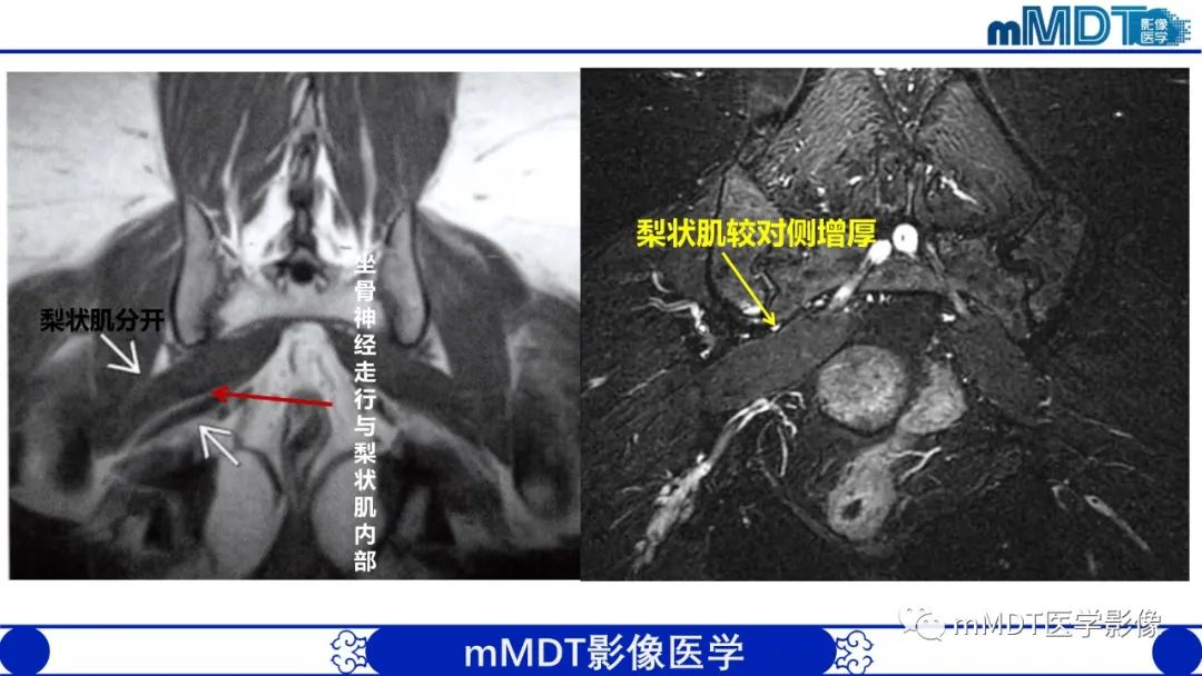 影像PPT - 【PPT】髋关节疼痛影像与临床(二)-16 影像PPT - 【PPT】髋关节疼痛影像与临床(二)-16
