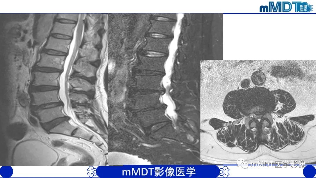 影像PPT - 【PPT】髋关节疼痛影像与临床(二)-18 影像PPT - 【PPT】髋关节疼痛影像与临床(二)-18