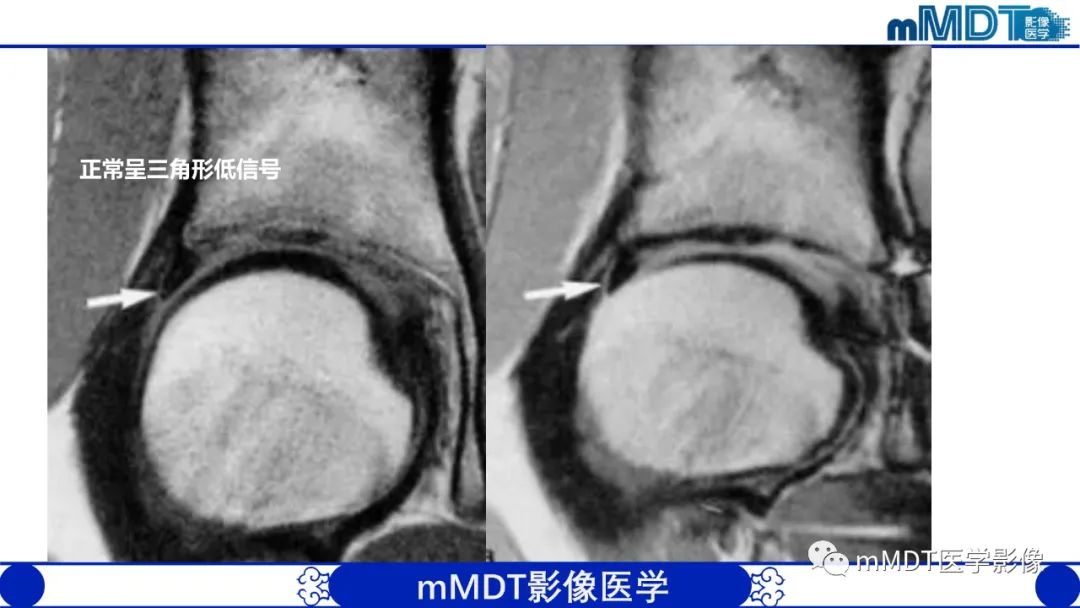 影像PPT - 【PPT】髋关节疼痛影像与临床(二)-22 影像PPT - 【PPT】髋关节疼痛影像与临床(二)-22