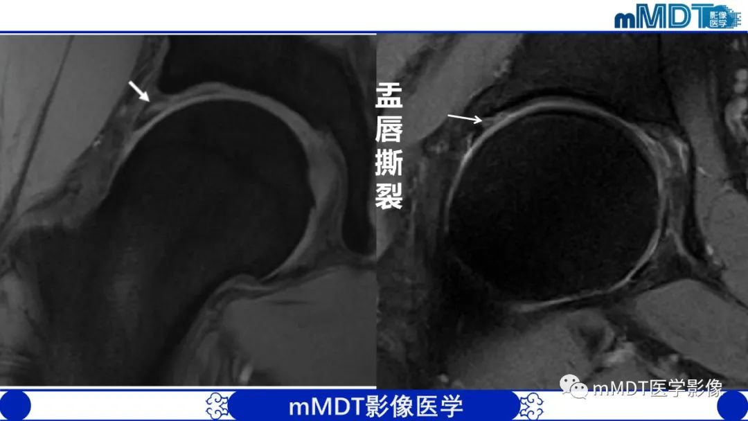 影像PPT - 【PPT】髋关节疼痛影像与临床(二)-23 影像PPT - 【PPT】髋关节疼痛影像与临床(二)-23