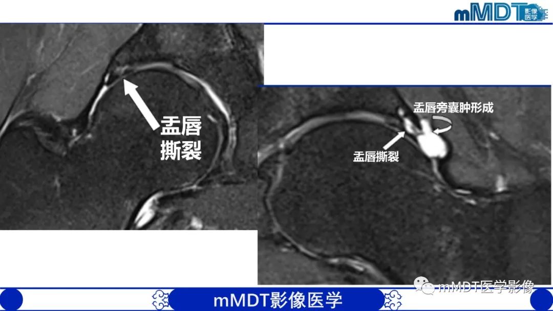 影像PPT - 【PPT】髋关节疼痛影像与临床(二)-24 影像PPT - 【PPT】髋关节疼痛影像与临床(二)-24