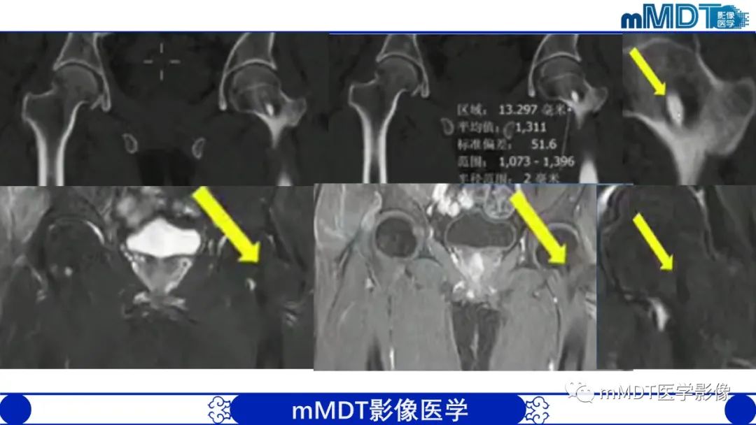 影像PPT - 【PPT】髋关节疼痛影像与临床(二)-27 影像PPT - 【PPT】髋关节疼痛影像与临床(二)-27