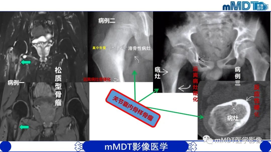 影像PPT - 【PPT】髋关节疼痛影像与临床(二)-30 影像PPT - 【PPT】髋关节疼痛影像与临床(二)-30