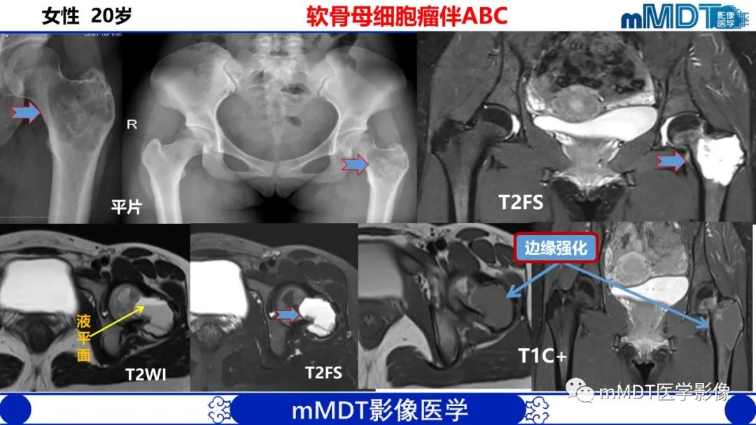 影像PPT - 【PPT】髋关节疼痛影像与临床(二)-34 影像PPT - 【PPT】髋关节疼痛影像与临床(二)-34