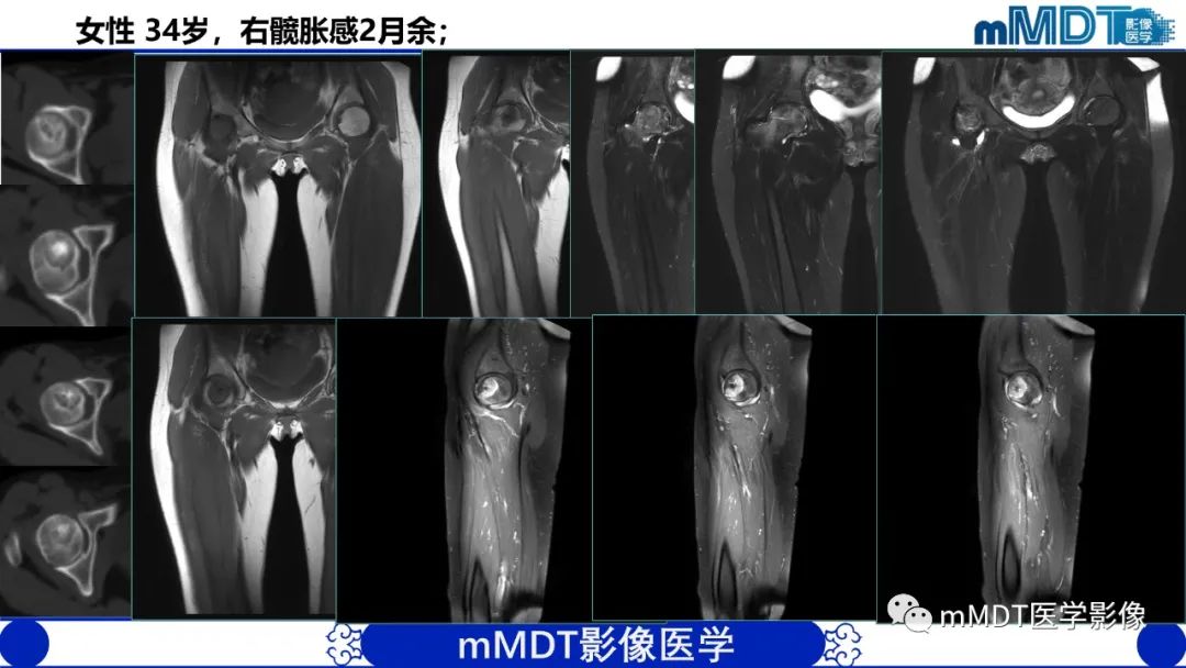 影像PPT - 【PPT】髋关节疼痛影像与临床(二)-37 影像PPT - 【PPT】髋关节疼痛影像与临床(二)-37