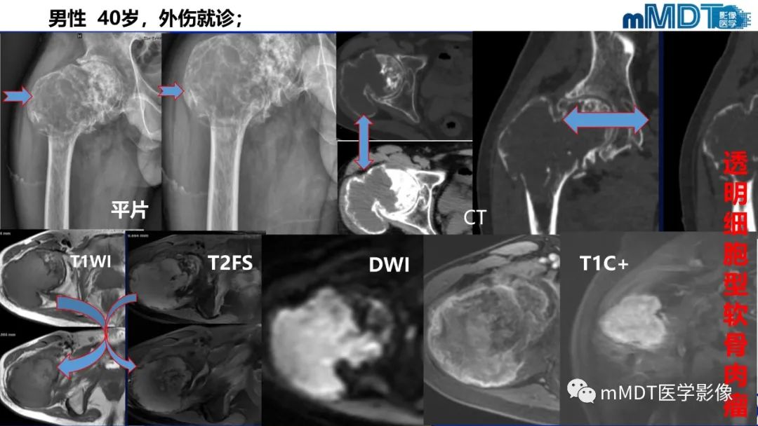 影像PPT - 【PPT】髋关节疼痛影像与临床(二)-36 影像PPT - 【PPT】髋关节疼痛影像与临床(二)-36
