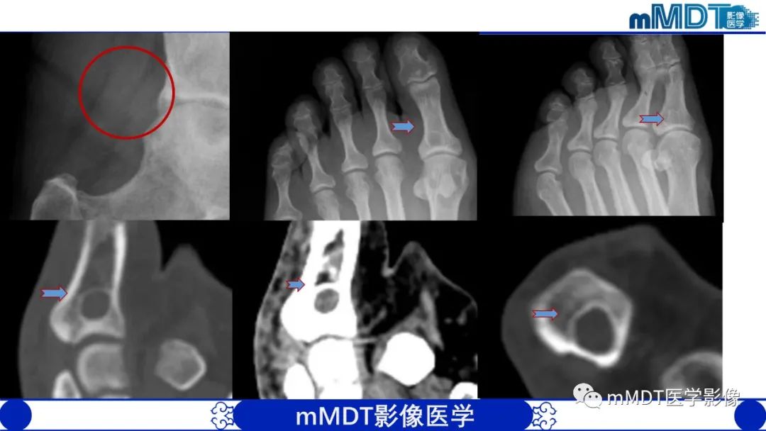 影像PPT - 【PPT】髋关节疼痛影像与临床(二)-39 影像PPT - 【PPT】髋关节疼痛影像与临床(二)-39