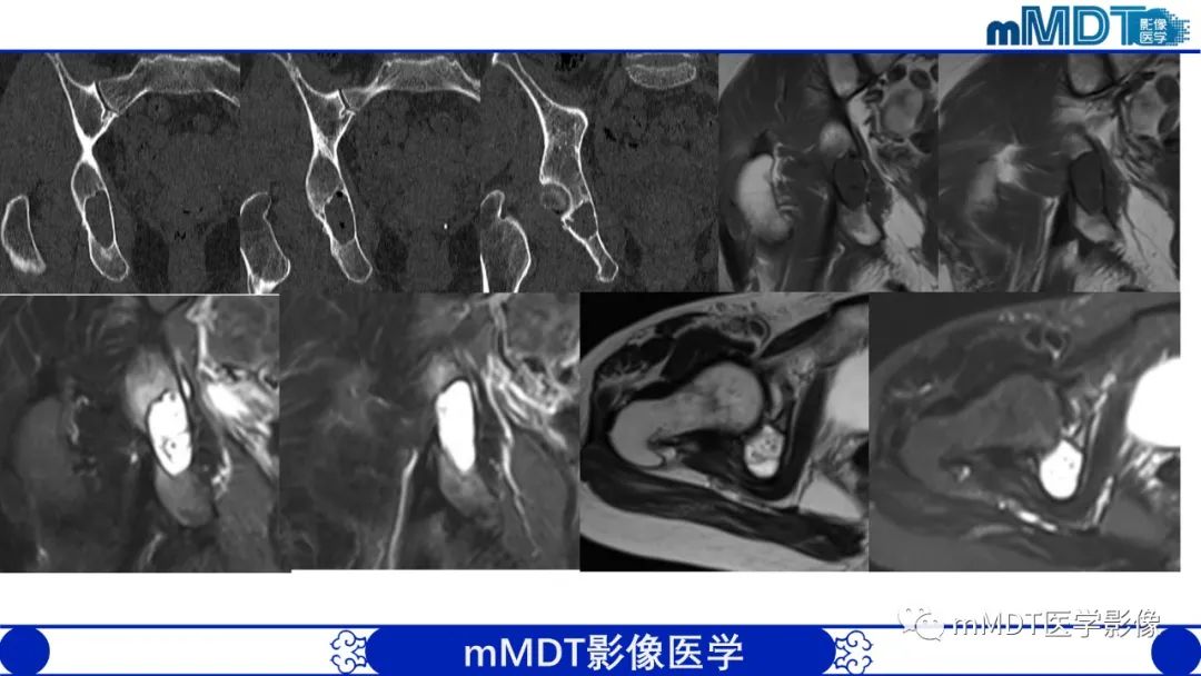 影像PPT - 【PPT】髋关节疼痛影像与临床(二)-41 影像PPT - 【PPT】髋关节疼痛影像与临床(二)-41