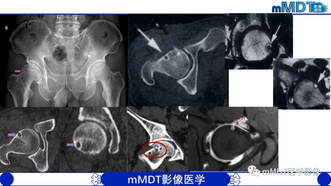 影像PPT - 【PPT】髋关节疼痛影像与临床(二)-43 影像PPT - 【PPT】髋关节疼痛影像与临床(二)-43