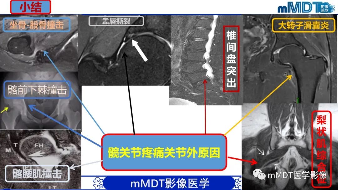 影像PPT - 【PPT】髋关节疼痛影像与临床(二)-44 影像PPT - 【PPT】髋关节疼痛影像与临床(二)-44